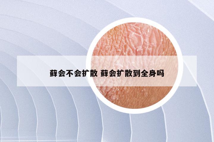 藓会不会扩散 藓会扩散到全身吗