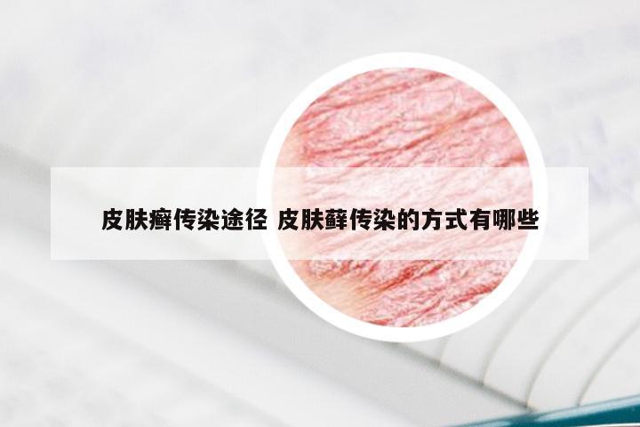 皮肤癣传染途径 皮肤藓传染的方式有哪些