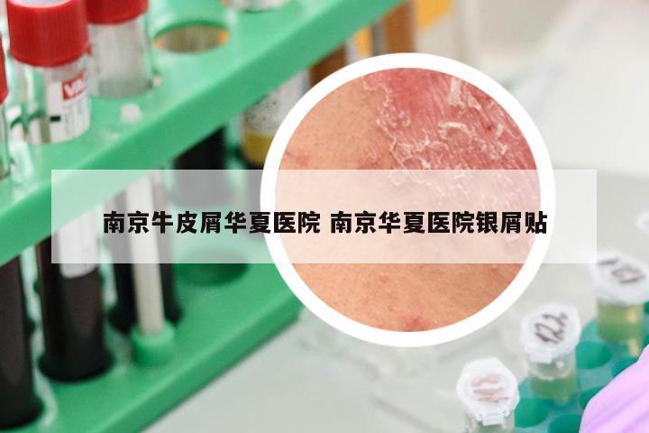 南京牛皮屑华夏医院 南京华夏医院银屑贴