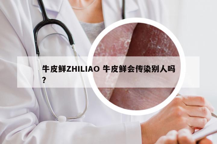 牛皮鲜ZHILIAO 牛皮鲜会传染别人吗?