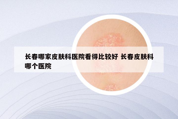 长春哪家皮肤科医院看得比较好 长春皮肤科哪个医院