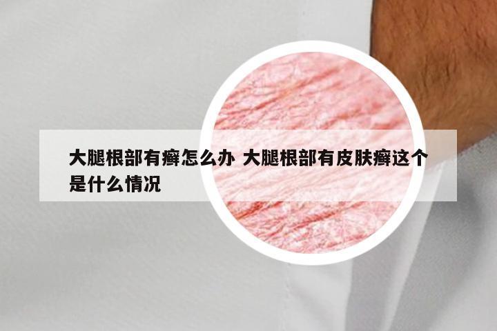 大腿根部有癣怎么办 大腿根部有皮肤癣这个是什么情况