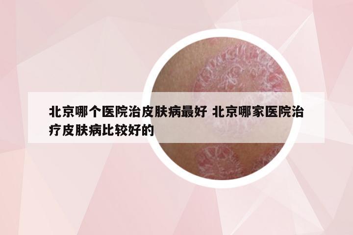 北京哪个医院治皮肤病最好 北京哪家医院治疗皮肤病比较好的