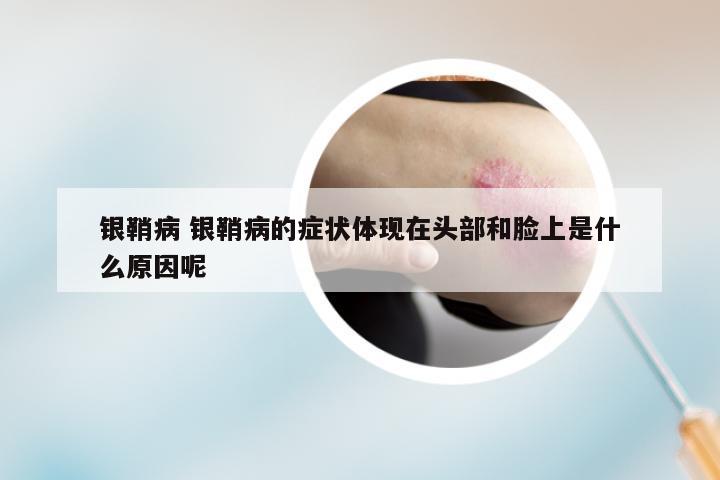 银鞘病 银鞘病的症状体现在头部和脸上是什么原因呢