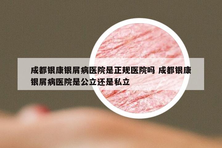 成都银康银屑病医院是正规医院吗 成都银康银屑病医院是公立还是私立
