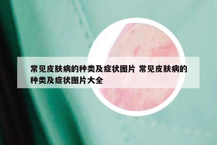 常见皮肤病的种类及症状图片 常见皮肤病的种类及症状图片大全
