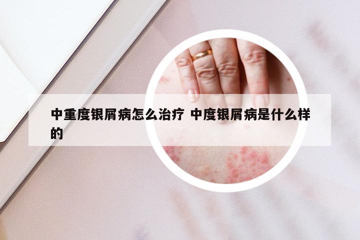 中重度银屑病怎么治疗 中度银屑病是什么样的