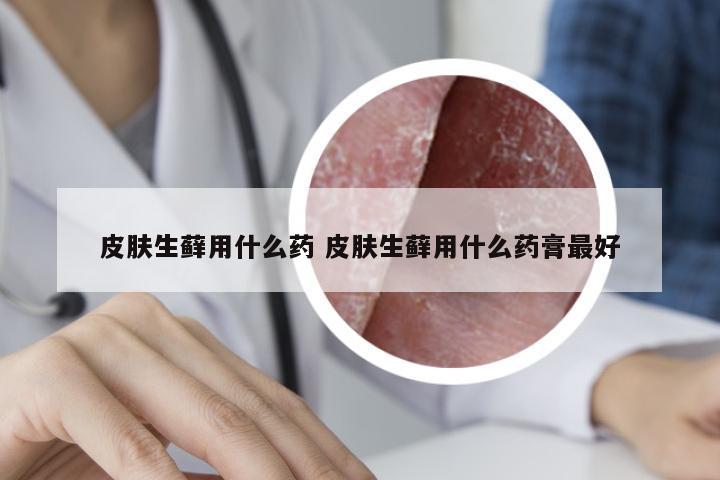 皮肤生藓用什么药 皮肤生藓用什么药膏最好
