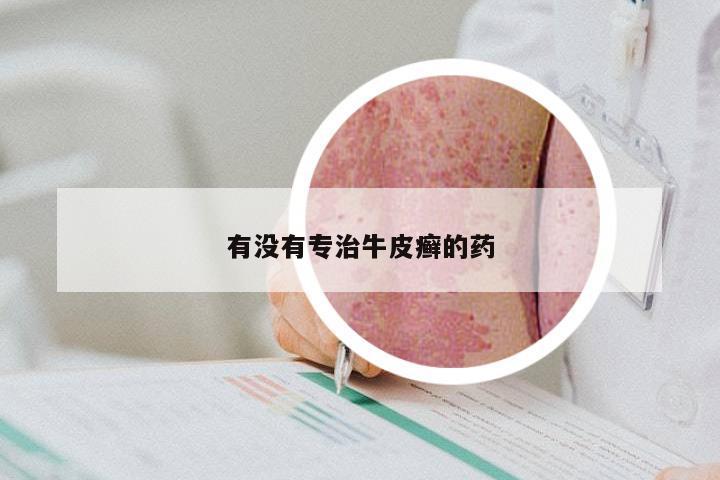 有没有专治牛皮癣的药
