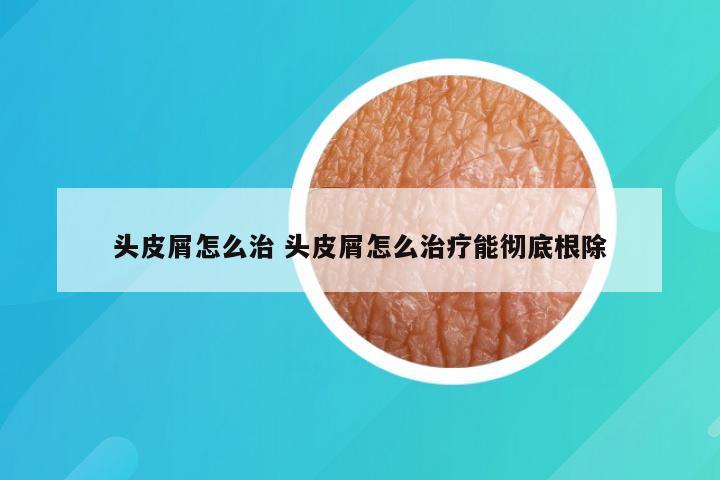 头皮屑怎么治 头皮屑怎么治疗能彻底根除