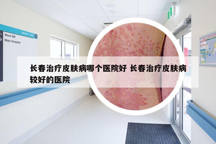 长春治疗皮肤病哪个医院好 长春治疗皮肤病较好的医院