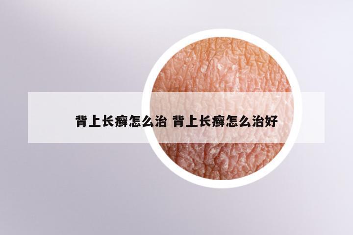 背上长癣怎么治 背上长癣怎么治好