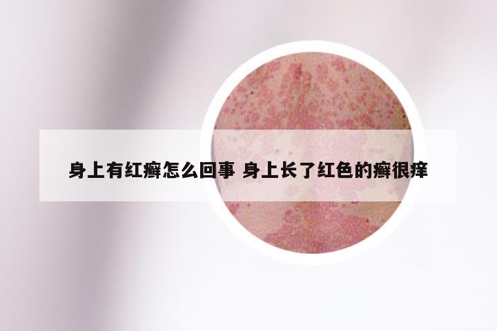 身上有红癣怎么回事 身上长了红色的癣很痒