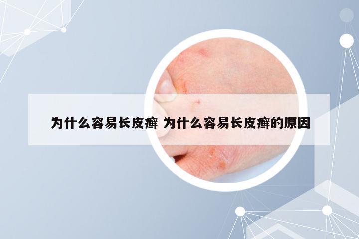 为什么容易长皮癣 为什么容易长皮癣的原因