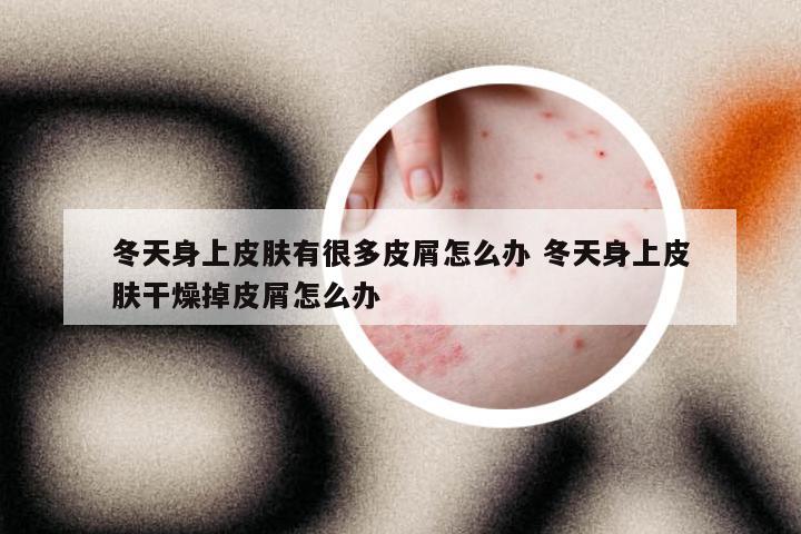 冬天身上皮肤有很多皮屑怎么办 冬天身上皮肤干燥掉皮屑怎么办