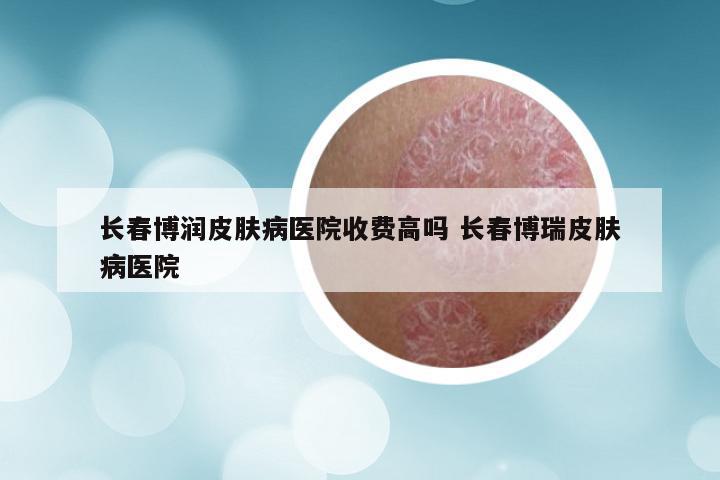 长春博润皮肤病医院收费高吗 长春博瑞皮肤病医院