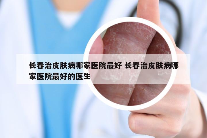 长春治皮肤病哪家医院最好 长春治皮肤病哪家医院最好的医生