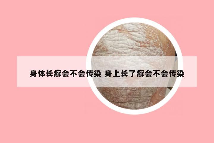 身体长癣会不会传染 身上长了癣会不会传染