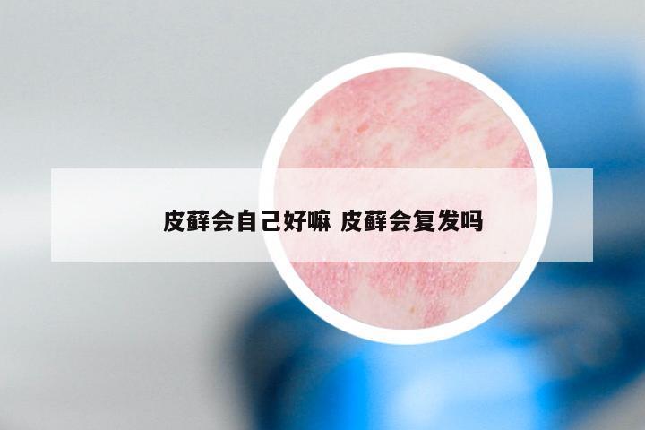 皮藓会自己好嘛 皮藓会复发吗