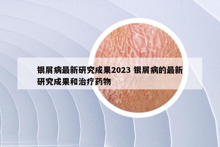 银屑病最新研究成果2023 银屑病的最新研究成果和治疗药物
