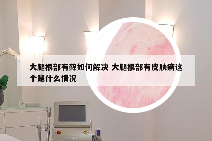 大腿根部有藓如何解决 大腿根部有皮肤癣这个是什么情况