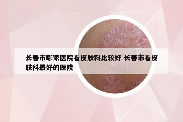 长春市哪家医院看皮肤科比较好 长春市看皮肤科最好的医院