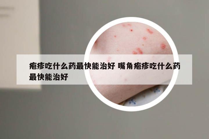 疱疹吃什么药最快能治好 嘴角疱疹吃什么药最快能治好