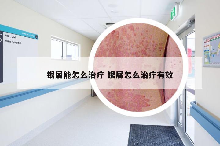 银屑能怎么治疗 银屑怎么治疗有效