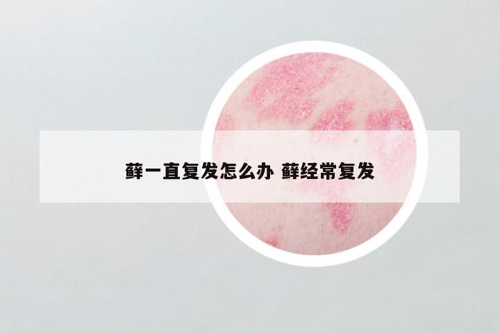 藓一直复发怎么办 藓经常复发