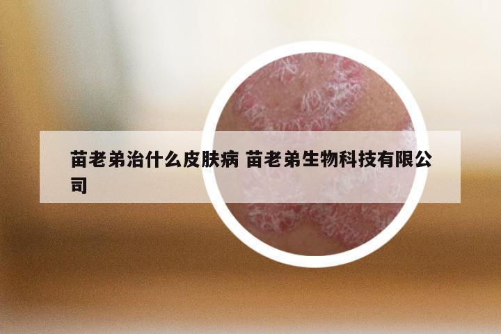 苗老弟治什么皮肤病 苗老弟生物科技有限公司