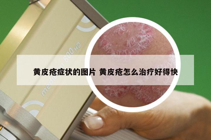 黄皮疮症状的图片 黄皮疮怎么治疗好得快