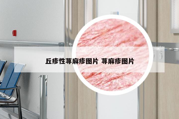 丘疹性荨麻疹图片 荨麻疹图片