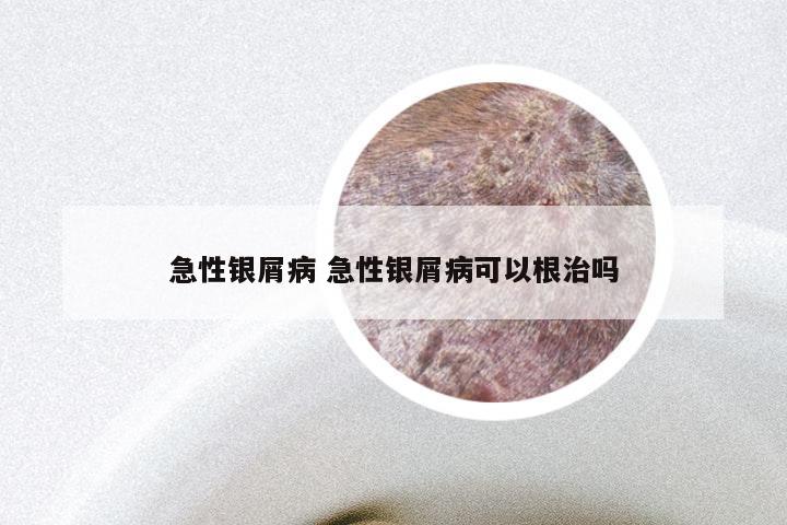 急性银屑病 急性银屑病可以根治吗