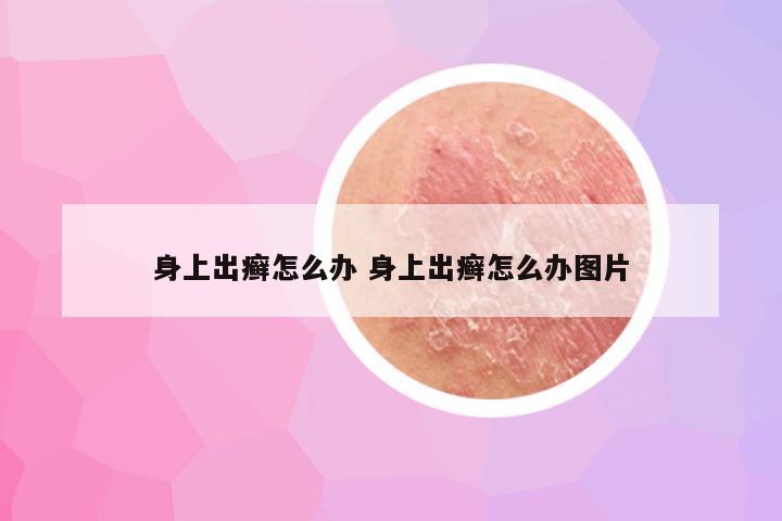 身上出癣怎么办 身上出癣怎么办图片