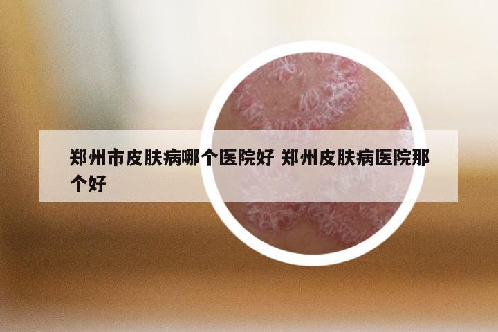 郑州市皮肤病哪个医院好 郑州皮肤病医院那个好