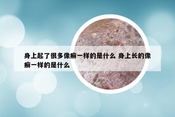 身上起了很多像癣一样的是什么 身上长的像癣一样的是什么