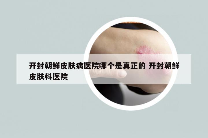 开封朝鲜皮肤病医院哪个是真正的 开封朝鲜皮肤科医院
