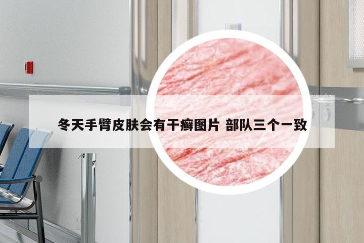 冬天手臂皮肤会有干癣图片 部队三个一致