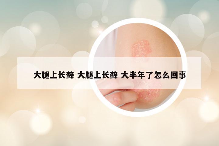 大腿上长藓 大腿上长藓 大半年了怎么回事