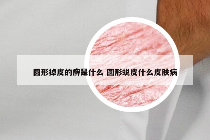 圆形掉皮的癣是什么 圆形蜕皮什么皮肤病