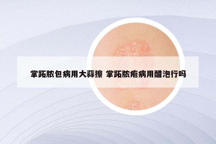 掌跖脓包病用大蒜擦 掌跖脓疱病用醋泡行吗