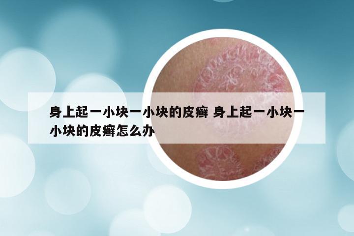 身上起一小块一小块的皮癣 身上起一小块一小块的皮癣怎么办