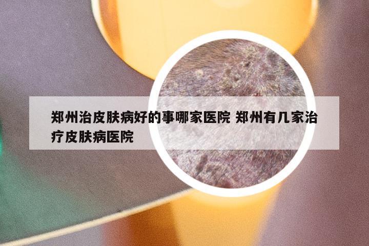 郑州治皮肤病好的事哪家医院 郑州有几家治疗皮肤病医院