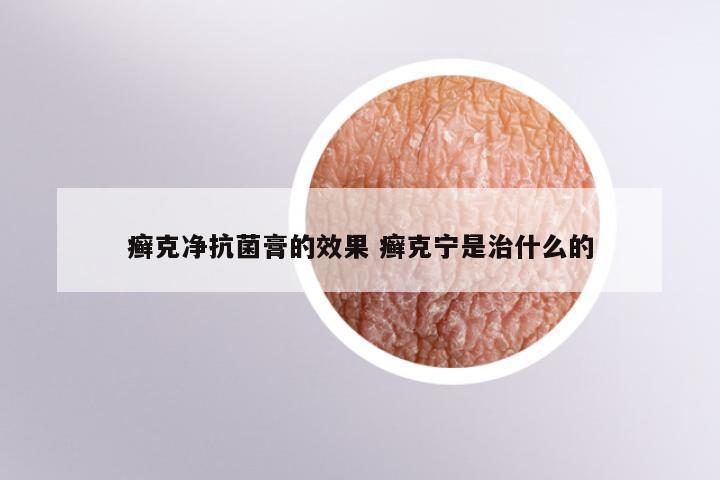癣克净抗菌膏的效果 癣克宁是治什么的