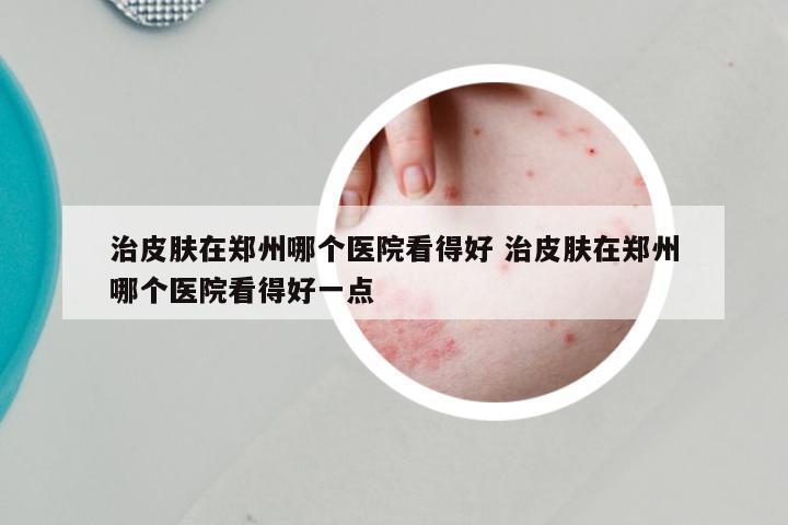 治皮肤在郑州哪个医院看得好 治皮肤在郑州哪个医院看得好一点