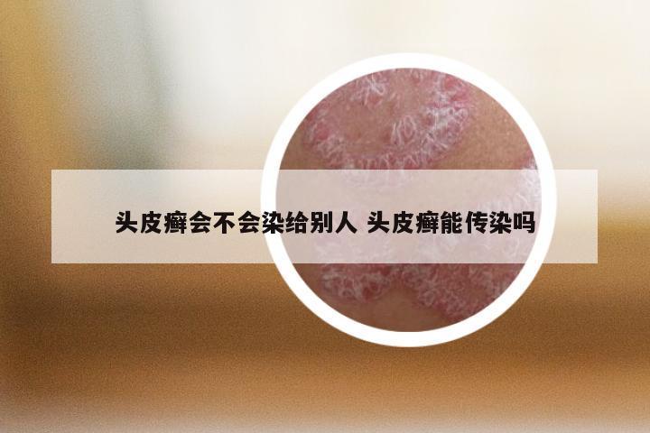 头皮癣会不会染给别人 头皮癣能传染吗