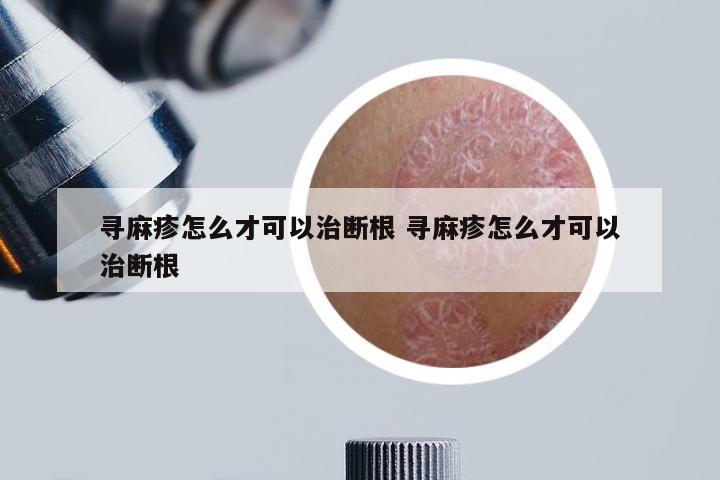 寻麻疹怎么才可以治断根 寻麻疹怎么才可以治断根
