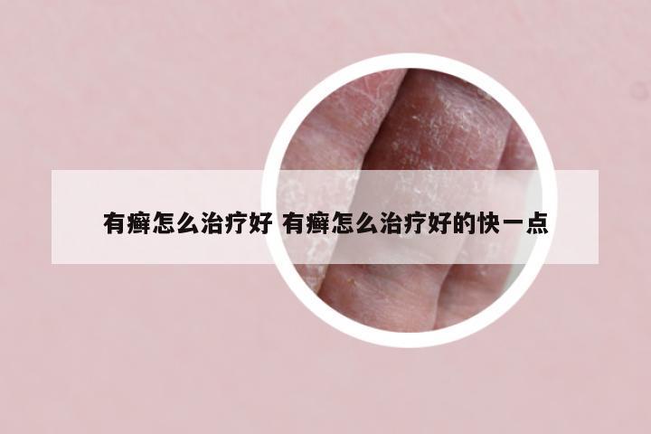 有癣怎么治疗好 有癣怎么治疗好的快一点
