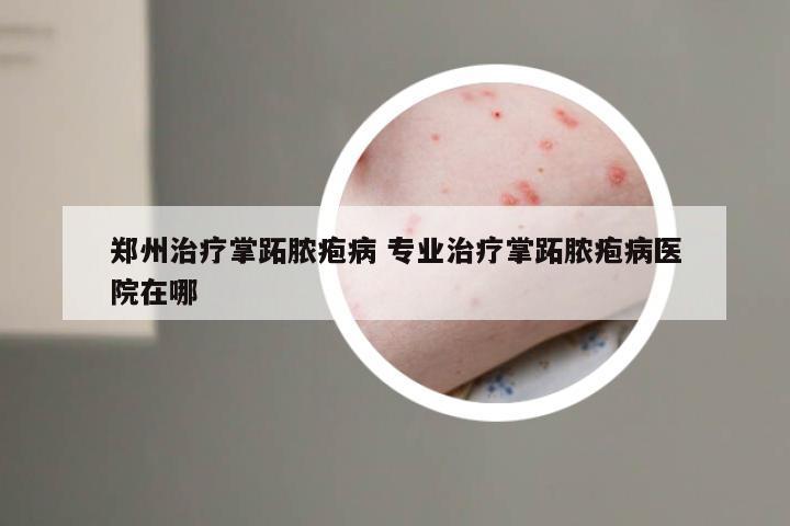郑州治疗掌跖脓疱病 专业治疗掌跖脓疱病医院在哪