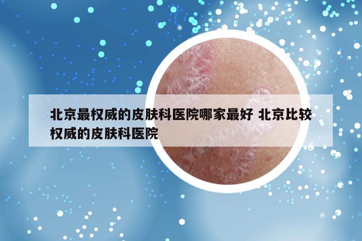 北京最权威的皮肤科医院哪家最好 北京比较权威的皮肤科医院